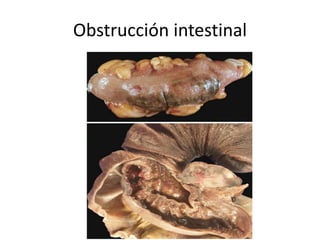 Obstrucción intestinal
 