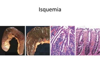 Isquemia
 