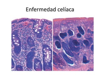 Enfermedad celíaca
 