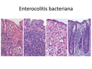 Enterocolitis bacteriana
 