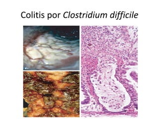 Colitis por Clostridium difficile
 