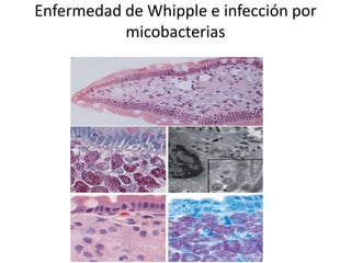 Enfermedad de Whipple e infección por
micobacterias
 