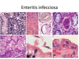 Enteritis infecciosa
 