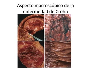 Aspecto macroscópico de la
enfermedad de Crohn
 