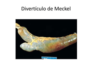 Divertículo de Meckel
 