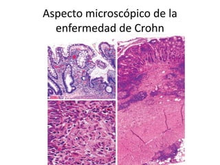Aspecto microscópico de la
enfermedad de Crohn
 