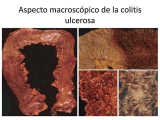 Aspecto macroscópico de la colitis
ulcerosa
 