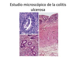 Estudio microscópico de la colitis
ulcerosa
 