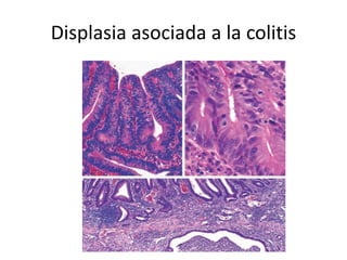 Displasia asociada a la colitis
 