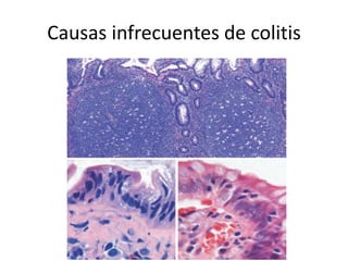 Causas infrecuentes de colitis
 