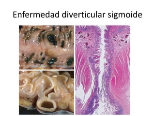 Enfermedad diverticular sigmoide
 