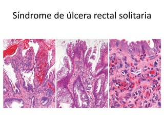 Síndrome de úlcera rectal solitaria
 