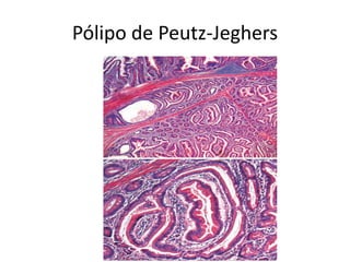 Pólipo de Peutz-Jeghers
 