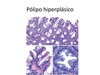 Pólipo hiperplásico
 