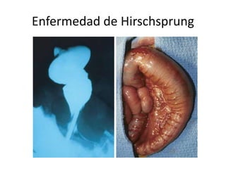 Enfermedad de Hirschsprung
 