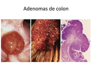 Adenomas de colon
 
