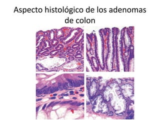 Aspecto histológico de los adenomas
de colon
 