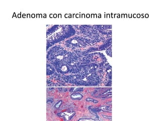 Adenoma con carcinoma intramucoso
 