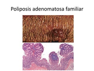 Poliposis adenomatosa familiar
 