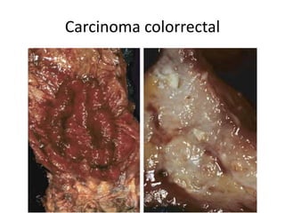 Carcinoma colorrectal
 
