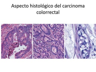 Aspecto histológico del carcinoma
colorrectal
 