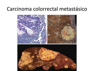 Carcinoma colorrectal metastásico
 