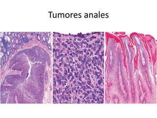 Tumores anales
 
