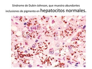 Síndrome de Dubin-Johnson, que muestra abundantes
inclusiones de pigmento en hepatocitos normales.
 