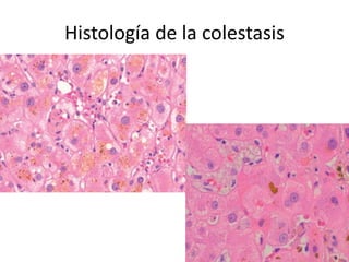Histología de la colestasis
 