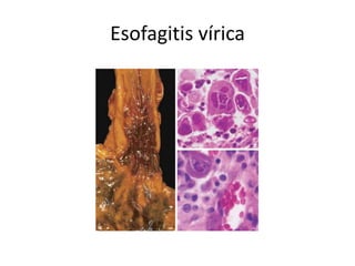 Esofagitis vírica
 