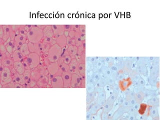 Infección crónica por VHB
 