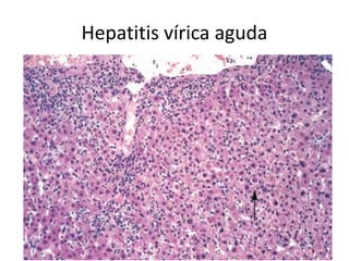 Hepatitis vírica aguda
 