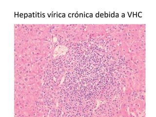 Hepatitis vírica crónica debida a VHC
 