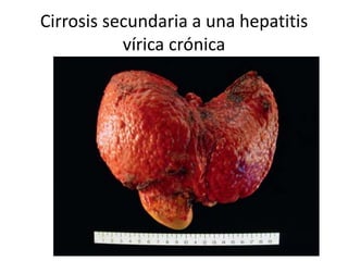 Cirrosis secundaria a una hepatitis
vírica crónica
 