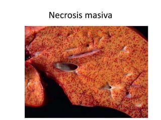 Necrosis masiva
 