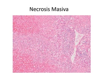 Necrosis Masiva
 