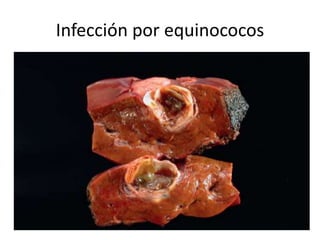 Infección por equinococos
 