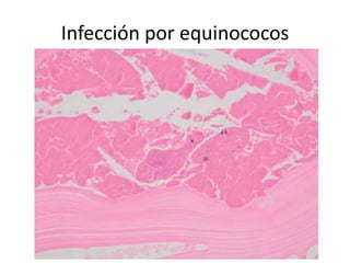 Infección por equinococos
 