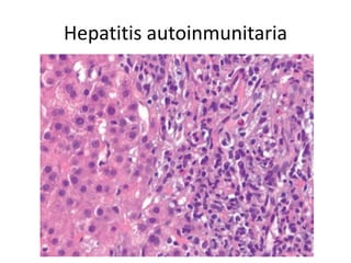 Hepatitis autoinmunitaria
 