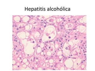 Hepatitis alcohólica
 