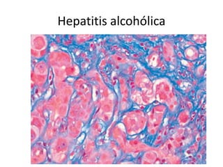 Hepatitis alcohólica
 