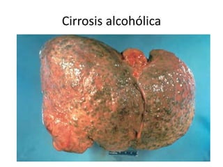 Cirrosis alcohólica
 