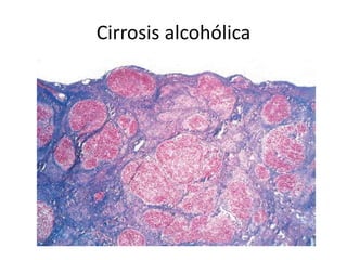 Cirrosis alcohólica
 