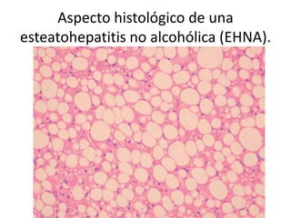 Aspecto histológico de una
esteatohepatitis no alcohólica (EHNA).
 