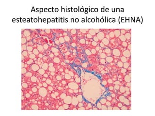 Aspecto histológico de una
esteatohepatitis no alcohólica (EHNA)
 