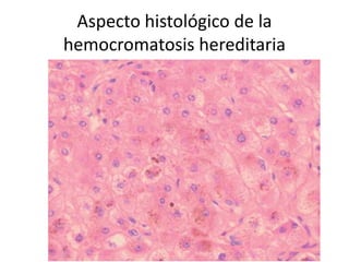 Aspecto histológico de la
hemocromatosis hereditaria
 