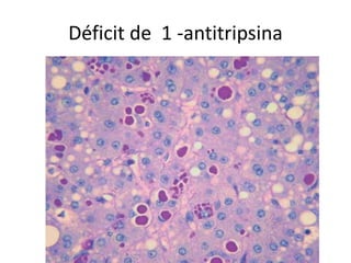 Déficit de 1 -antitripsina
 
