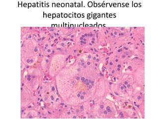 Hepatitis neonatal. Obsérvense los
hepatocitos gigantes
multinucleados.
 