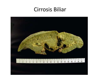 Cirrosis Biliar
 