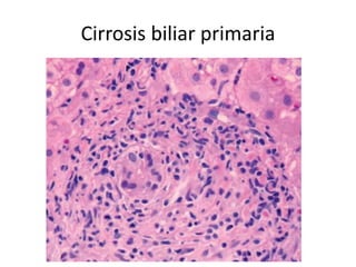 Cirrosis biliar primaria
 